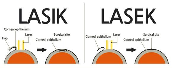 LASIK and LASEK surgery diagrams