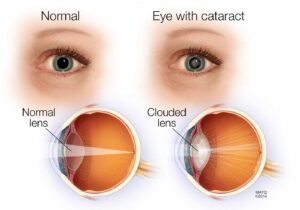 Normal Eye vs Eye with Cataract