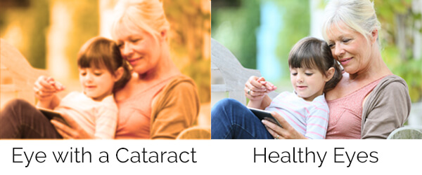 Eye with Cataract v. Health Eye
