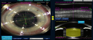 All-Laser Cataract Surgery