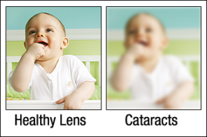 Chart Showing What a Healthy Eye Sees Compared to One With Cataracts
