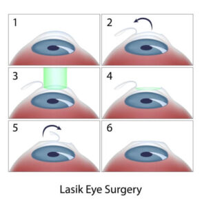A step by step explanation of LASIK surgery