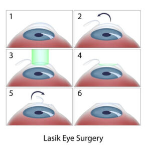 lasik eye surgery procedure