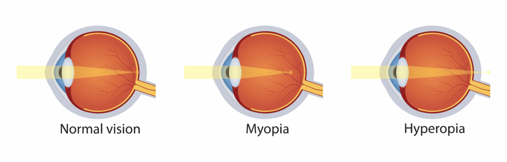 Diagram showing how Myopia Management slows eye elongation vs normal vision.
